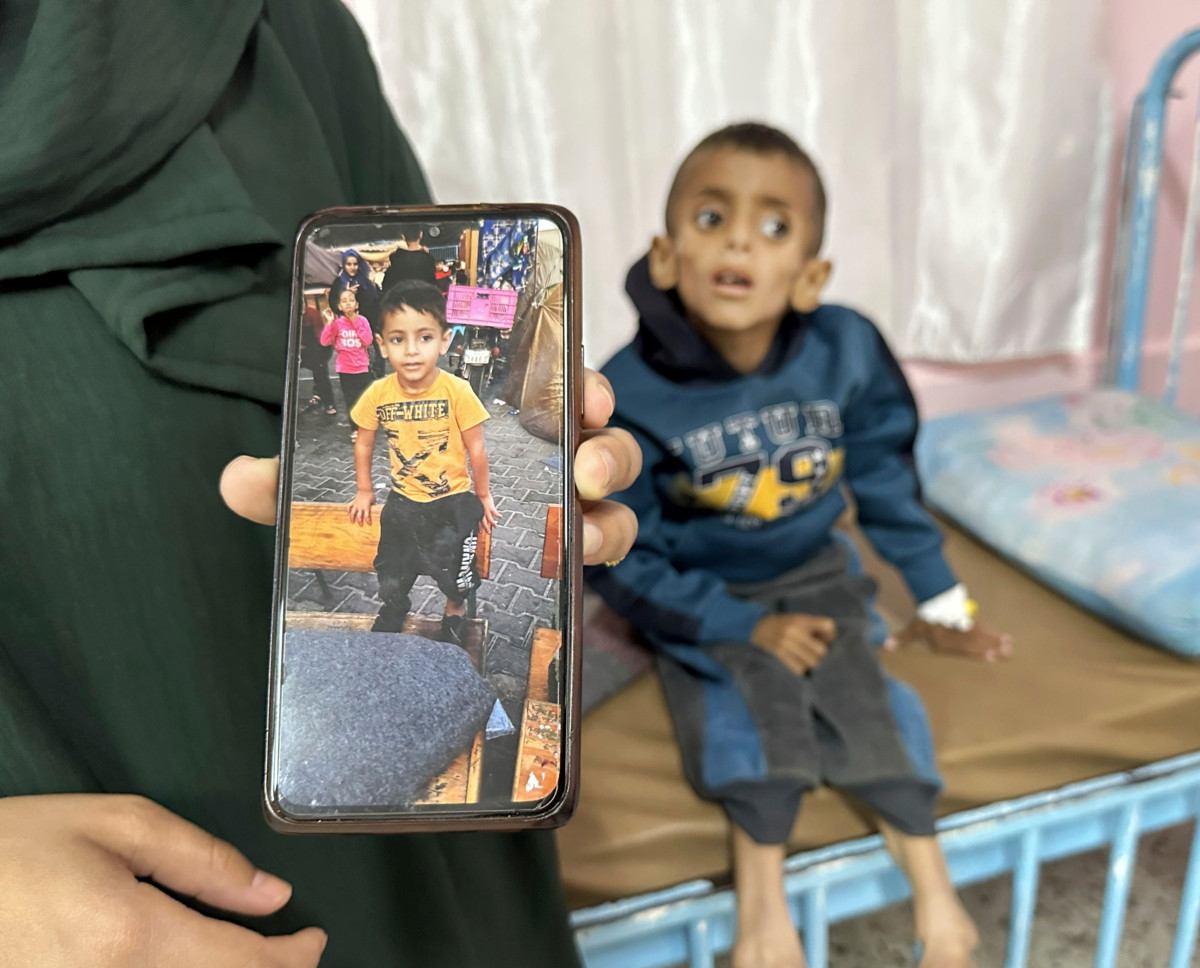 Palestiinalainen Osama Al-Ruqab kärsii vakavasta aliravitsemuksesta. Kuva: Moaz Abu Tahal/Polarisimages/Lehtikuva