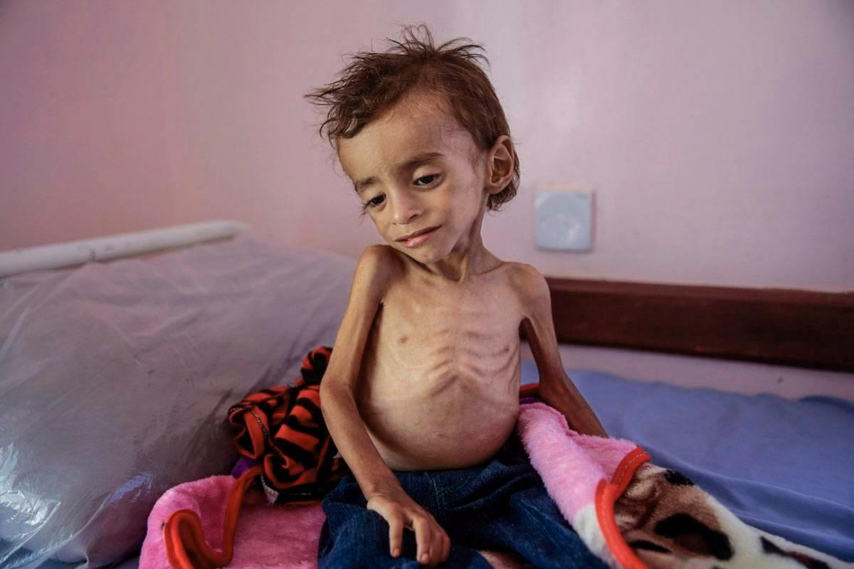 Jemenin sodassa on kuollut kymmeniätuhansia lapsia nälkään.