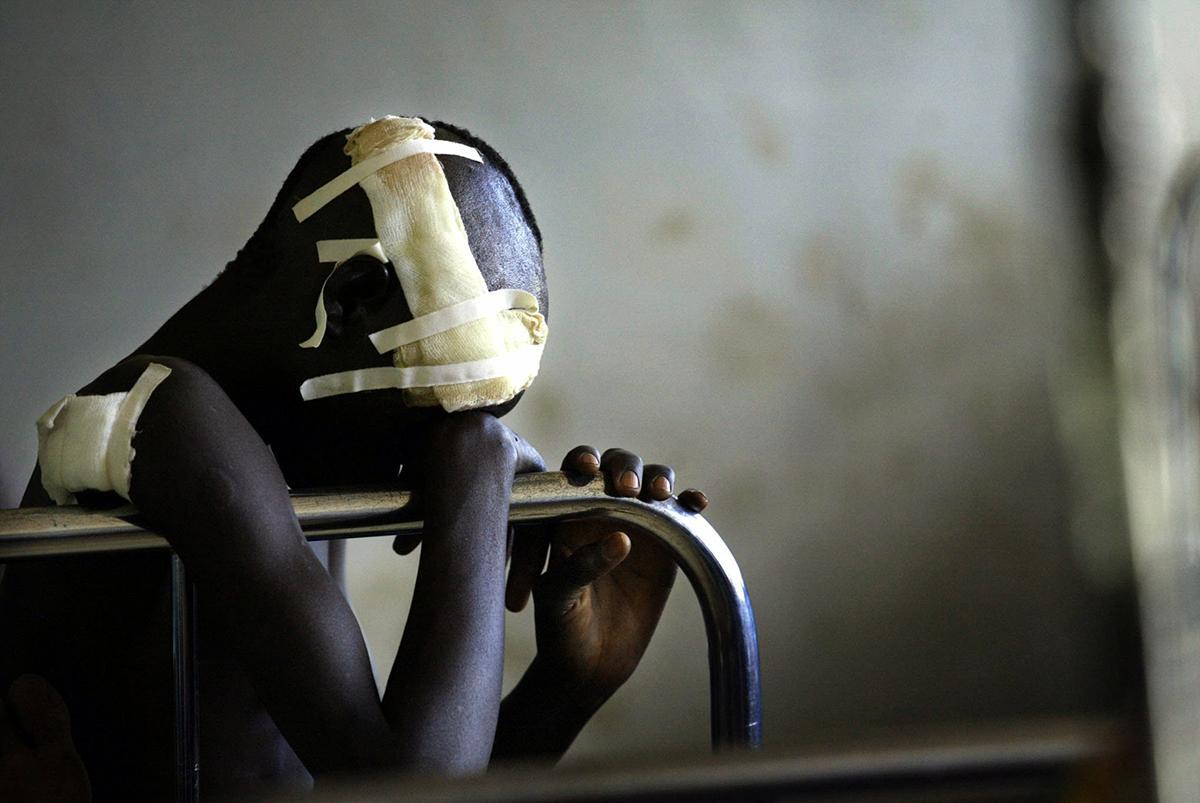 Nuori mies haavoittui Herran vastarinta-armeijan (LRA) iskussa Lirassa Pohjois-Ugandassa vuonna 2003. Siviilit joutuivat pitkässä sisällissodassa sekä Ugandan hallituksen että LRA:n väkivallan kohteiksi. Kuva: Marco Longari / AFP/ Lehtikuva